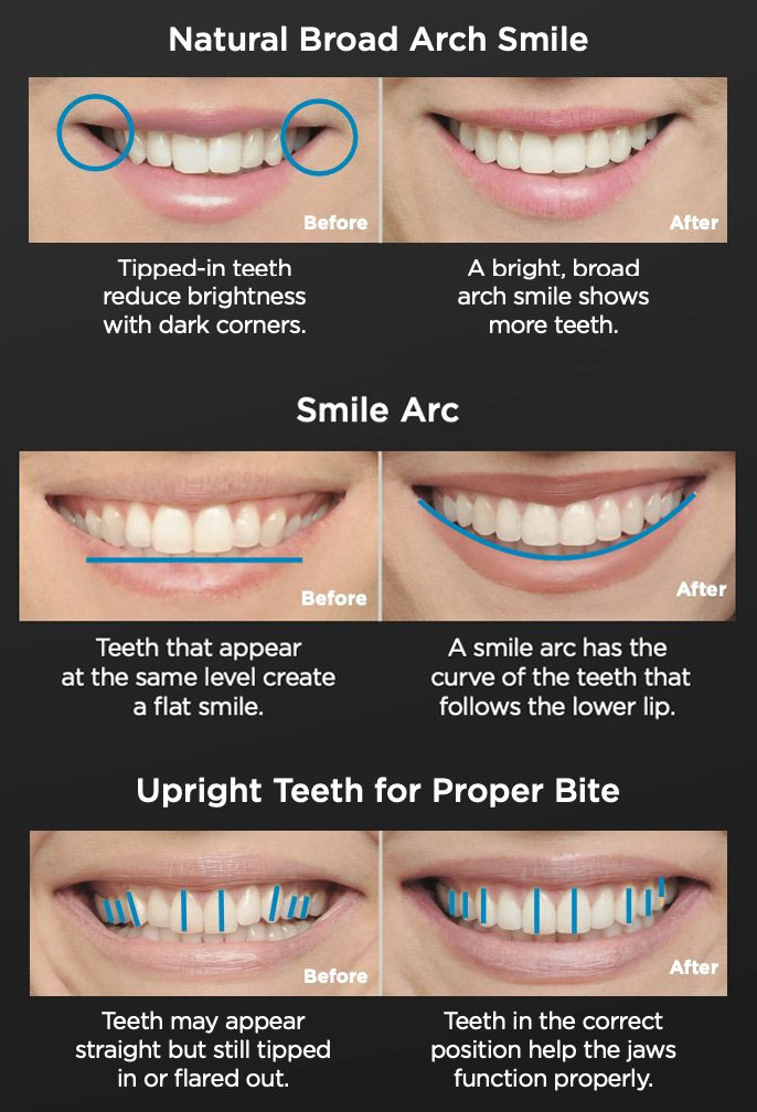 This image illustrates the potential results of orthodontic treatment, such as braces, showing improvements in smile arc and bite. Such services may be available in Henderson, NV.